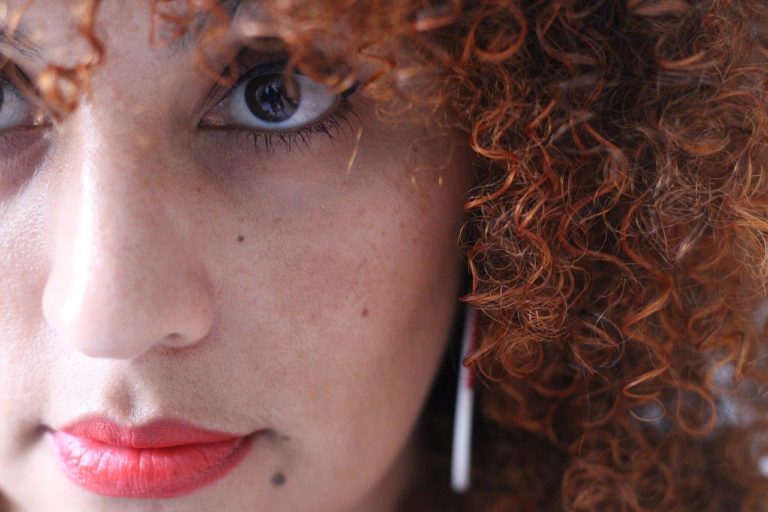 A Guide to Treating Melasma: What you Need to Know
