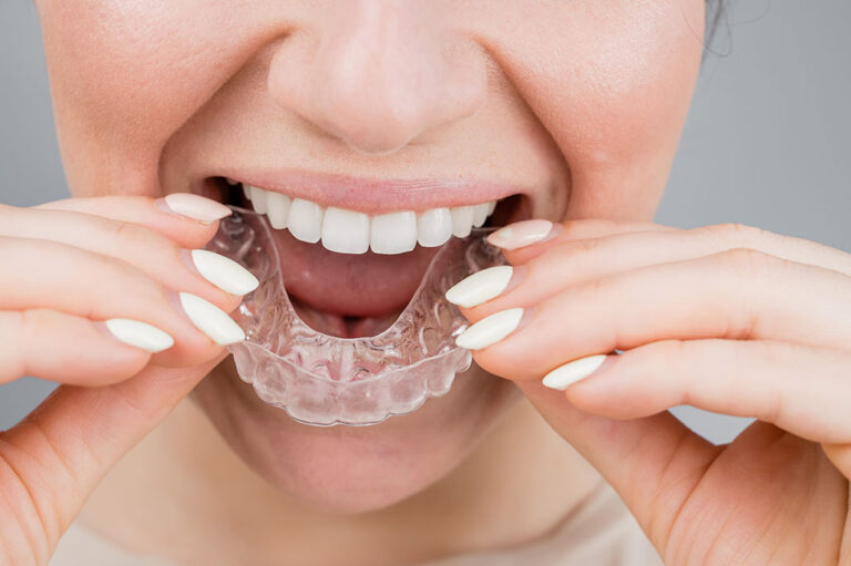 Clear Aligners: Capable, But Not a Cure-All: Here’s What They Can Actually Do