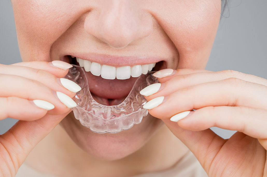 Clear Aligners: Capable, But Not a Cure-All: Here’s What They Can Actually Do